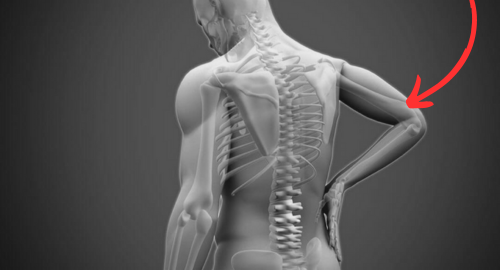 a Herniated Disc